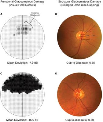 Progression of functional and structural glaucomatous damage in relation to diurnal and nocturnal dips in mean arterial pressure